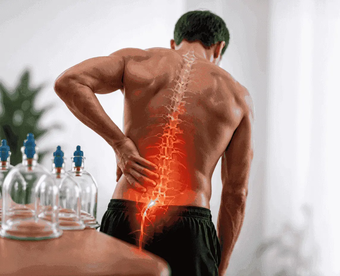 Cupping for Sciatica: Does It Really Relieve the Pain? Evidence, Points & Sessions | Khaled Al-Zallal